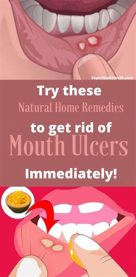 31 Home Remedies to get rid of Mouth Ulcers (Mouth Sores) in 2020 | Mouth ulcers, Canker sore ...