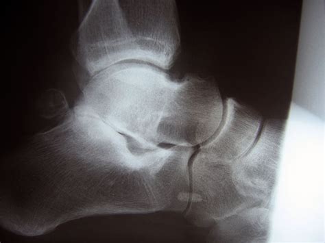 Subtalar Arthritis | Foot + Ankle Arthroscopy | Atlanta | Georgia