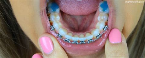 Adult Braces Update 5 | 6 Month Braces Update