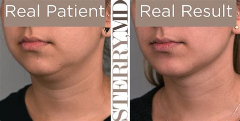 buccal face fat removal near me - Shizue Houser