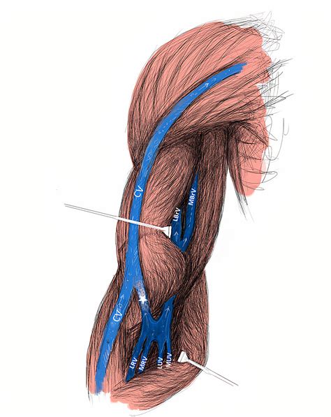 Cureus | A Thick Anastomotic Vein Between Cephalic and Lateral Radial Veins: Clinical ...