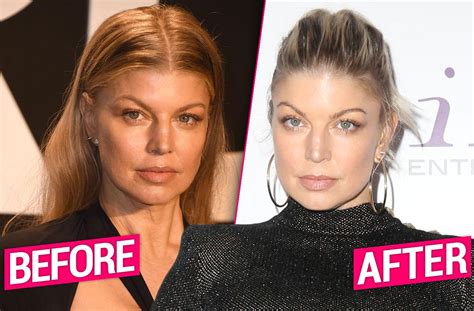 Fergie's Post-Divorce Plastic Surgery Makeover Revealed By Top Docs