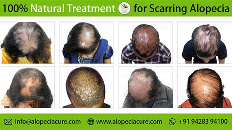 Scarring alopecia (Cicatricial alopecia) Treatment and Types.