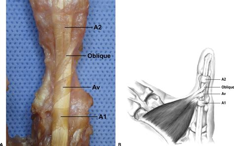 Varied Anatomy of the Thumb Pulley System: Implications for Successful Trigger Thumb Release ...