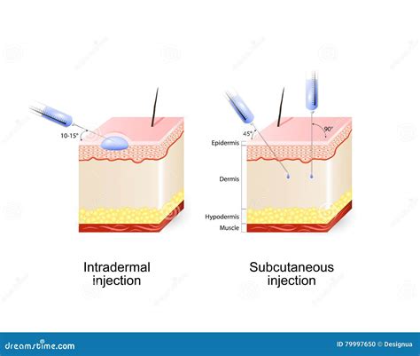 Intradermal and Subcutaneous Injection Stock Vector - Illustration of ...