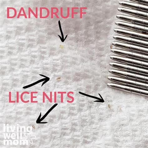 How to get rid of lice nits without chemicals – Artofit