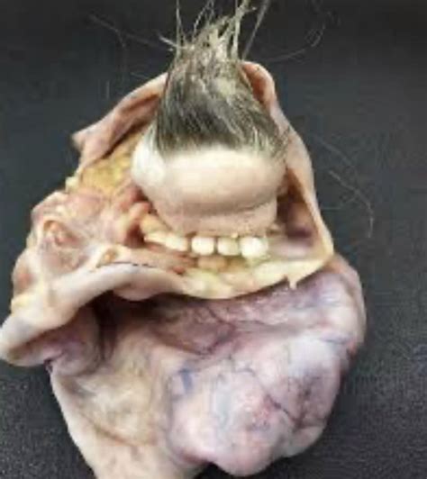 This is what a teratoma — a tumor that can grow teeth, eyes, hair, etc. — looks like. : r/nope