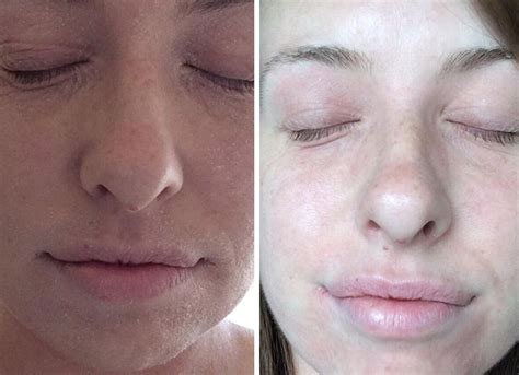 A before-and-after skin transformation has gone viral after a Reddit forum user shared the story ...