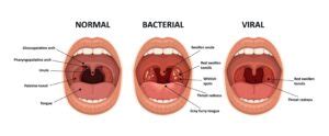 Tonsillitis - tapGP