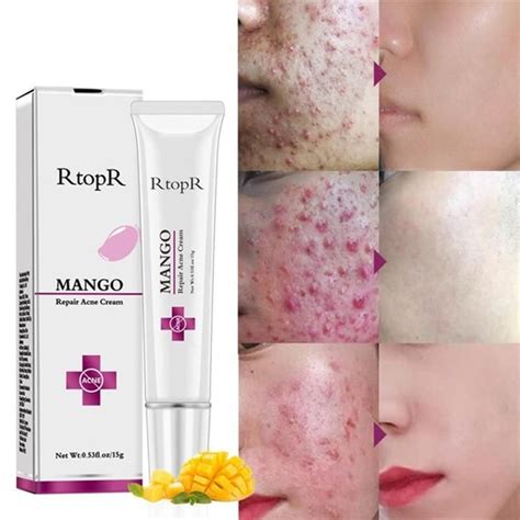 Creme Removedor Cicatrizes E Marcas De Acne – Frete Grátis (com imagens) | Marcas de acne ...