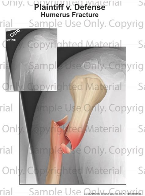 Humerus Fracture Injury - MotionLit