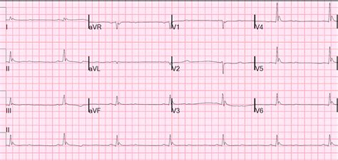 Dr. Smith's ECG Blog: Massive Osborn Waves of Severe Hypothermia (23.6 C), with Cardiac Echo