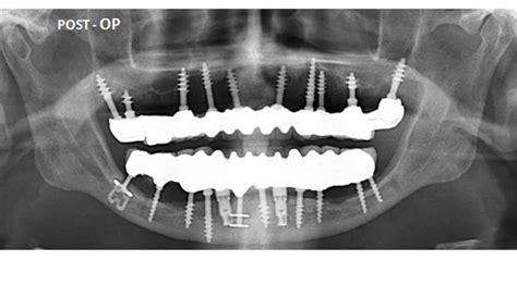 Basal Implants Delhi India Cost of Basal Dental Implants Delhi India