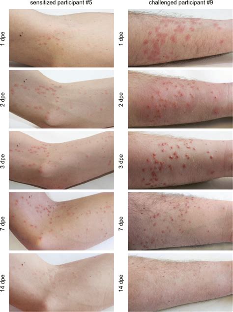 Cercarial dermatitis: a systematic follow-up study of human cases with implications for ...