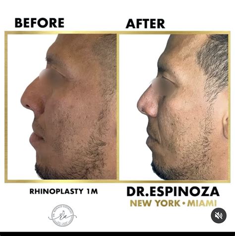 Rhinoplasty Gallery | Dr. Ronald Espinoza Cosmetic Plastic Surgery