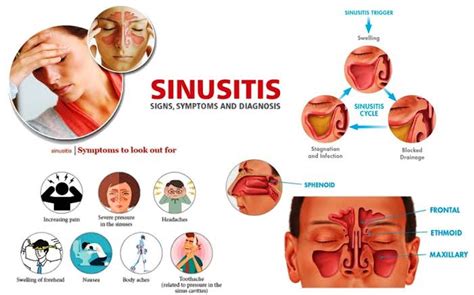 Sinus Infection (Sinusitis): Types, Causes, Symptoms and Treatment with Homeopathic Medicine