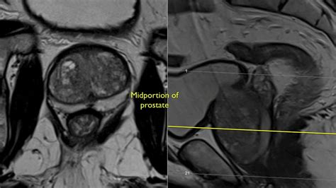 Prostate Gland Anatomy Mri