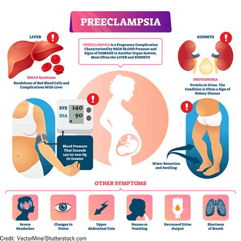 Ce Este Preeclampsia Si Care Sunt Simptomele Ei Bebebliss Ro | The Best Porn Website