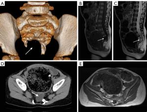 Characterization of complete Currarino syndrome in pediatrics—a comparison between CT and MRI ...