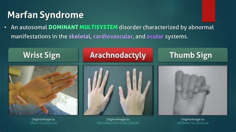 Marfan Syndrome Face