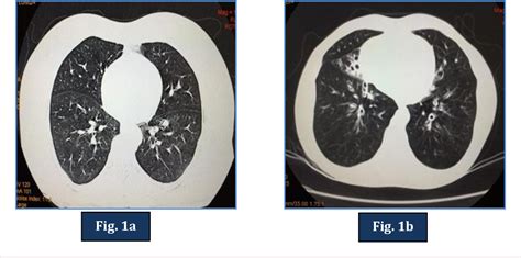 HRCT v/s MDCT: IN DETECTION OF BRONCHIECTASIS | Semantic Scholar