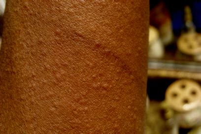 File:Cholinergic urticaria.jpg - Wikipedia