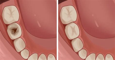 Researchers Regrow Teeth Damaged From Cavities | No More Fake Teeth - RankRed