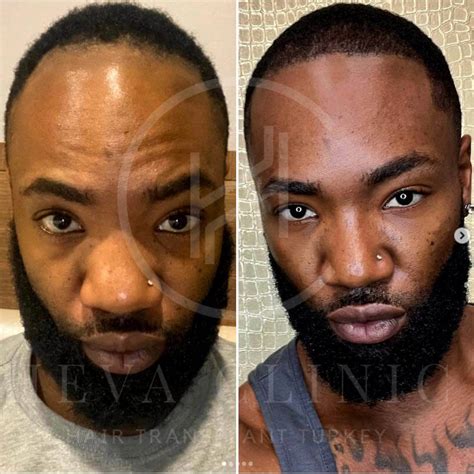 21 Black Celebrity Hair Transplants - Before & After Photos