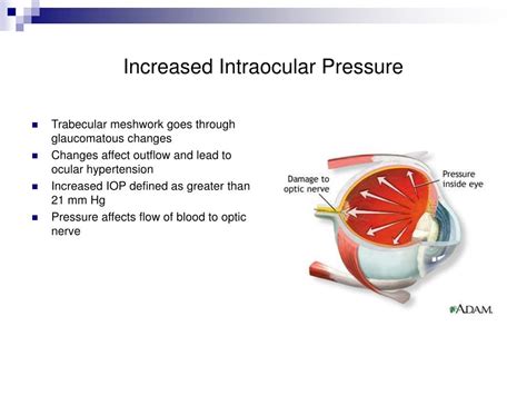 PPT - Glaucoma PowerPoint Presentation, free download - ID:5096621