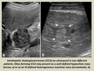 Presentation1.pptx, radiological imaging of cholangiocarcinoma. | PPT