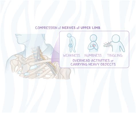 Thoracic Outlet Syndrome