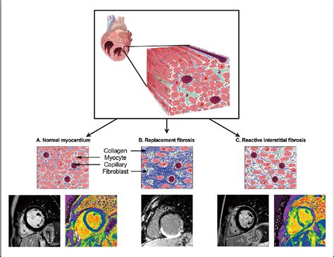 Figure 1 from Myocardial Fibrosis in Congenital Heart Disease. | Semantic Scholar