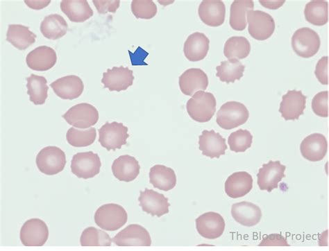 Echinocytes (Burr Cells) • The Blood Project