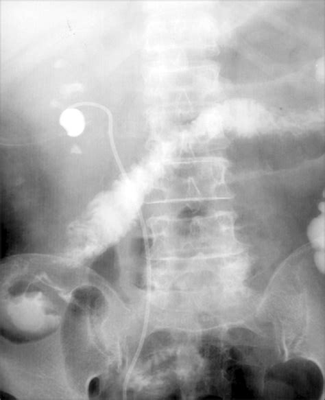 Figure 3:Percutaneous Nephroscopic Surgery- Open-i