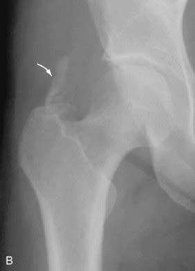 Soft Tissue Calcification and Ossification | Radiology Key