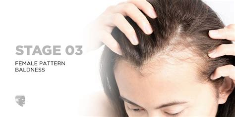 Female Pattern Baldness - Symptoms, Causes, Treatment and Prevention - AHS India