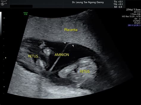 Twins - Classification and diagnosis - HKOG-INFO