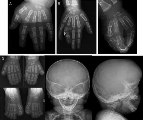 Different types of syndactyly. (A) Membranous mesoaxial (third web ...