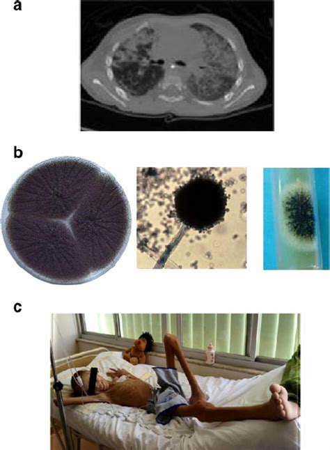 Pulmonary aspergillosis and Isospora belli infection in CD40L ...