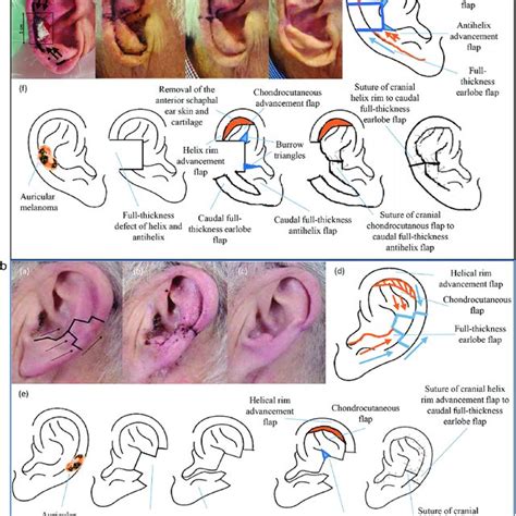 a: Repair of helix and antihelix defects using a retroauricular... | Download Scientific Diagram