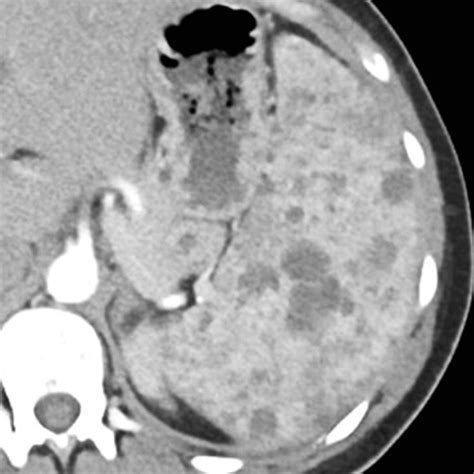 Spleen | Radiology Key