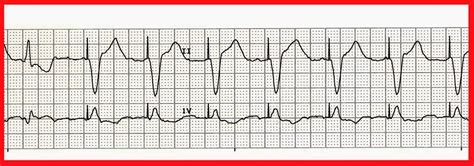 Float Nurse: Practice Rhythm Strips 302