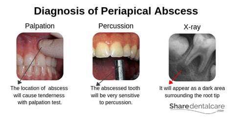 Periapical Abscess: Symptoms, Causes, & Treatment - Share Dental Care ...