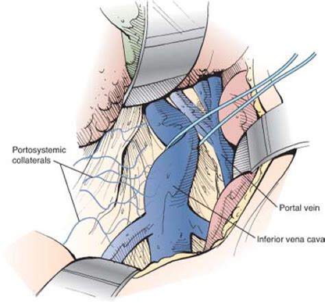 Anatomy of the Portal System and Experience with Portacaval Shunt ...