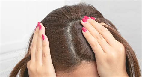 Dandruff Causes, Symptoms & Dandruff Treatment