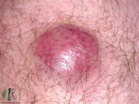 Images Of Merkel Cell Carcinoma Skin Cancer - CancerWalls