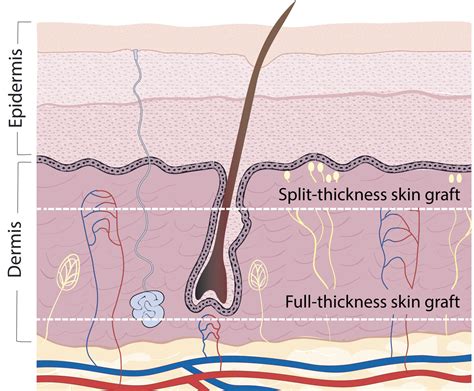 Split Thickness Skin Graft