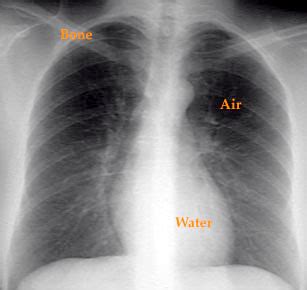 Chest x-ray as a diagnostic tool