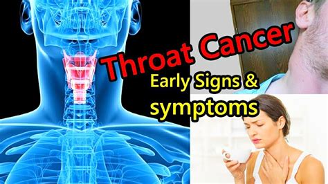 What Are The Symptoms Of Throat Cancer |Throat Cancer Symptoms - YouTube