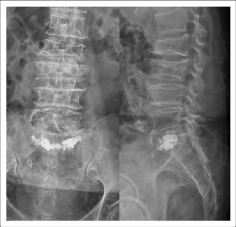 This patient underwent sacroplasty with balloon assistance.... | Download Scientific Diagram